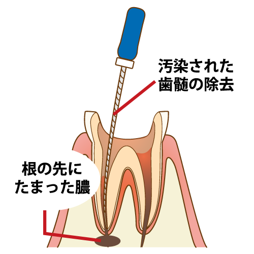 根幹治療（汚染された歯髄の除去）
