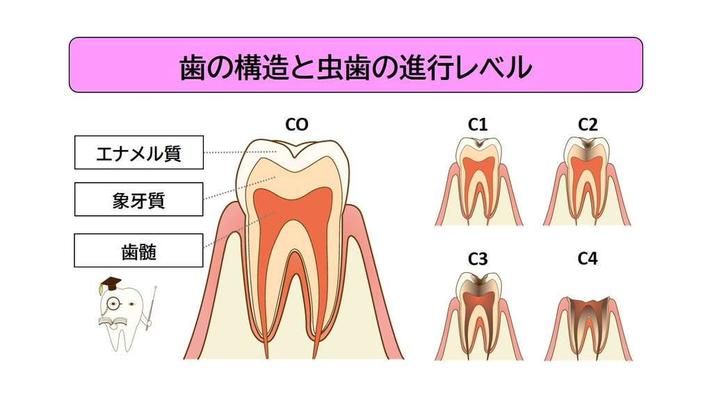 歯の神経を抜くのは虫歯が“歯髄”にまで進行した時