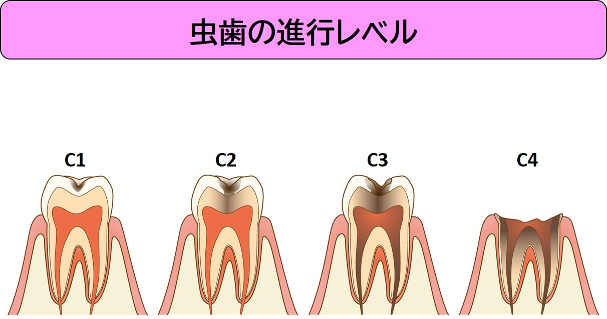 軽度 の 虫歯