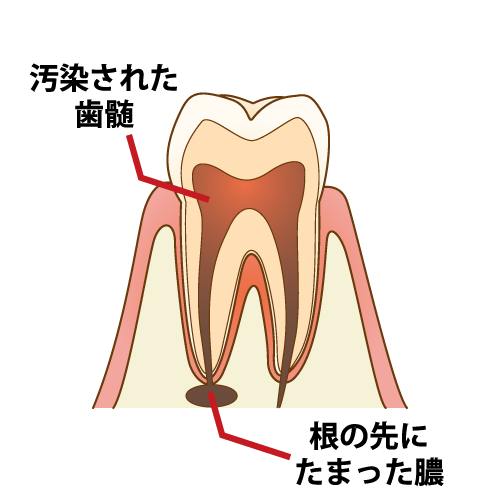 歯の神経が死ぬ原因と対処法 Teech
