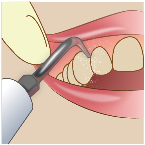 歯周病治療（歯のクリーニングである「PMTC」）