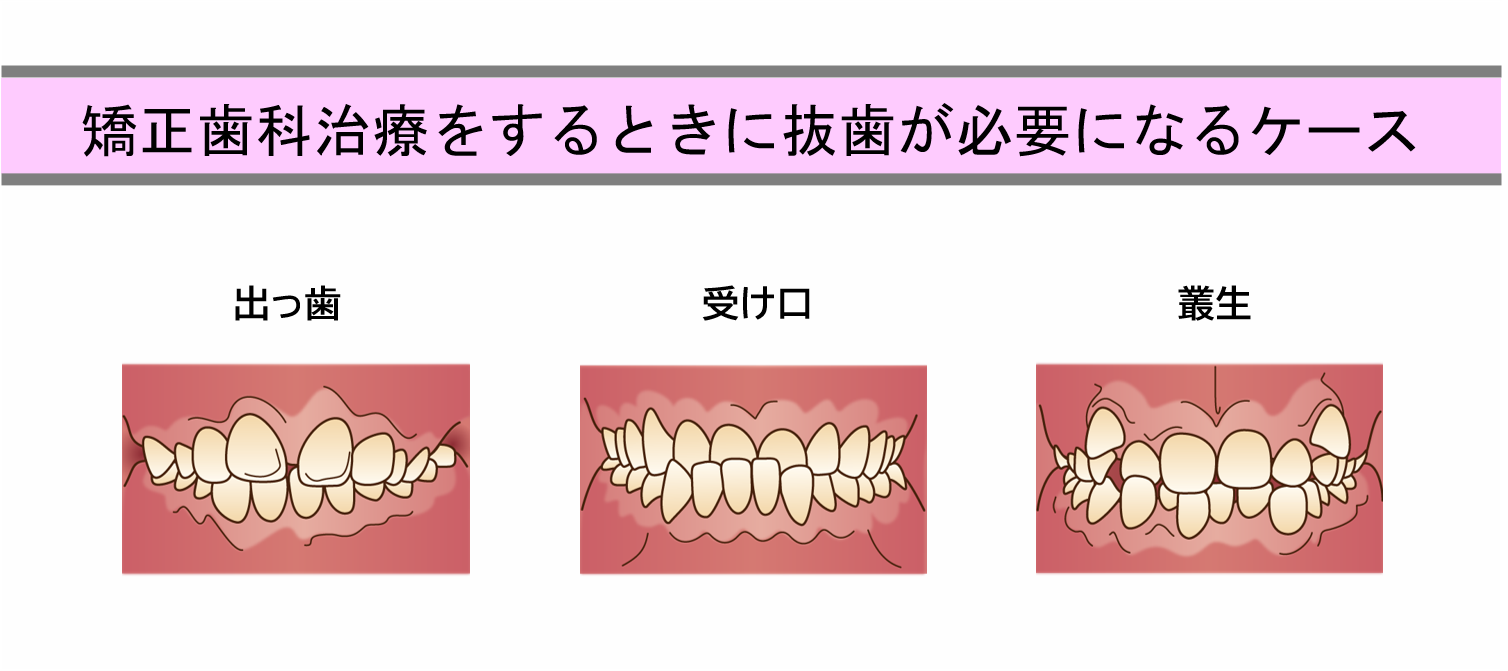 矯正歯科治療をするときに抜歯が必要になるケース