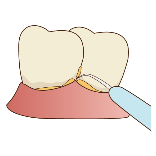 歯のクリーニングやスケーリング