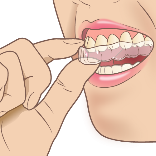 歯の矯正　インビザライン（マウスピース矯正）