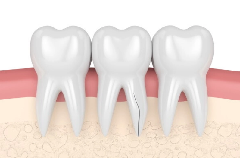 個々の歯の構造に合わせた丁寧な処置で歯の保存率を高める専門的アプローチ