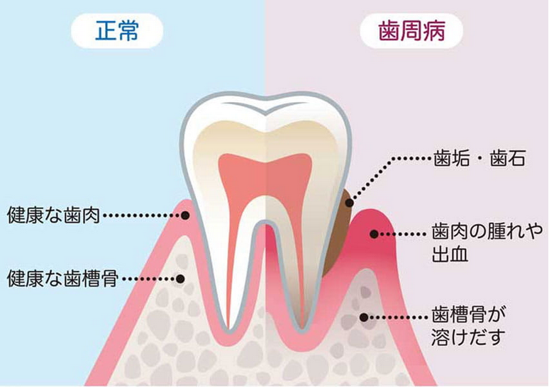歯周病は、妊婦さんにとっては早産のリスクを高める要因