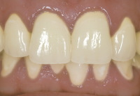 短時間できれいな歯を作れます