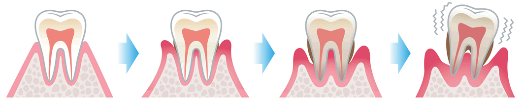 歯周病の怖さとえびぬま歯科の治療への取り組み