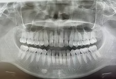 虫歯や骨の状態まで可視化して伝える診療スタイル