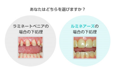 歯への負担が少ない治療です
