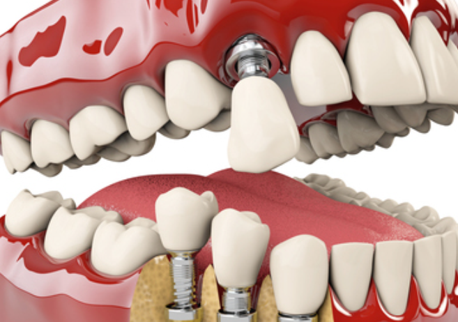 インプラント治療のイメージ