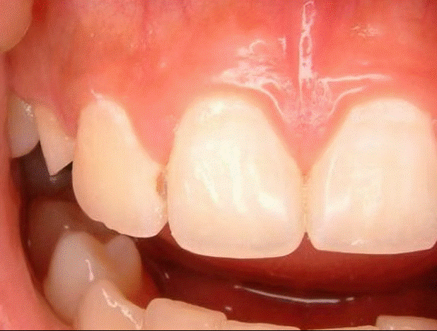 ただ削って詰めるのではなく、将来的に健康な歯を残すことを大切にした診療を実践しています
