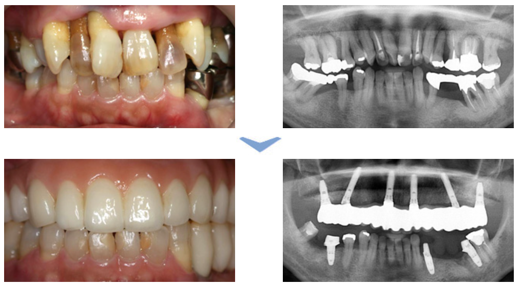 実際に施術した患者様の一例です