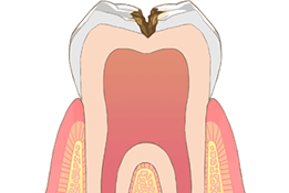 治療後も定期的なメンテナンスを通じて虫歯の再発防止に力を入れています