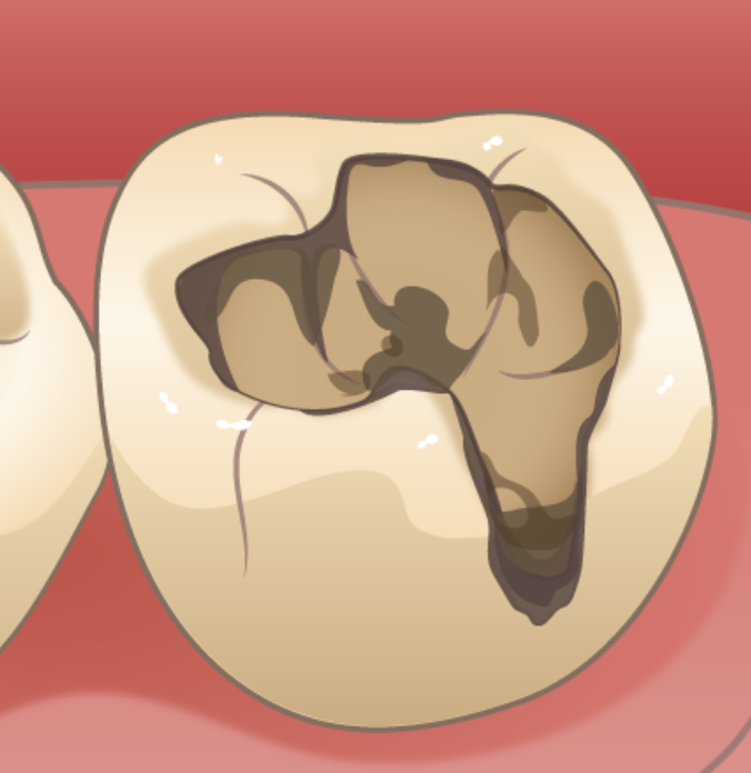 むし歯予防に取り組んでいます