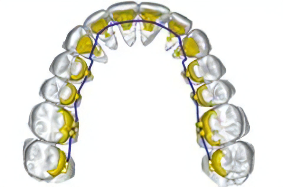 より精度の高い裏側の矯正治療