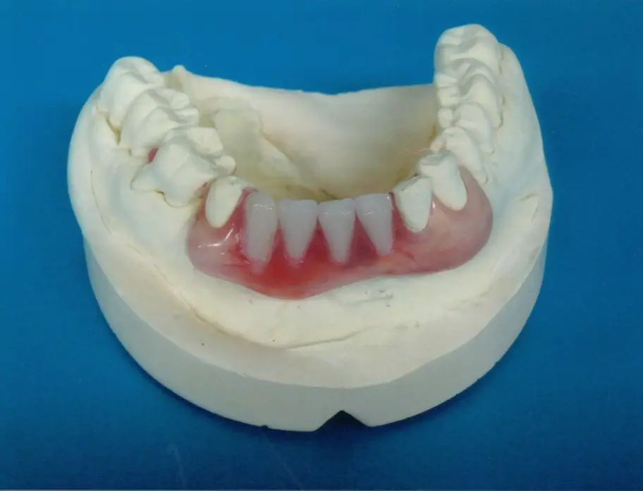 バネが目立たないノンクラスプデンチャーも対応
