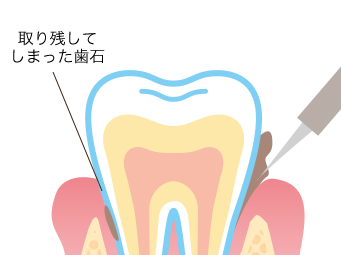 再発を防ぐための環境づくりを大切にし、長期的な視点で歯周病と向き合う治療を心がけています