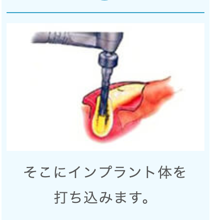 正確なインプラント治療を行います
