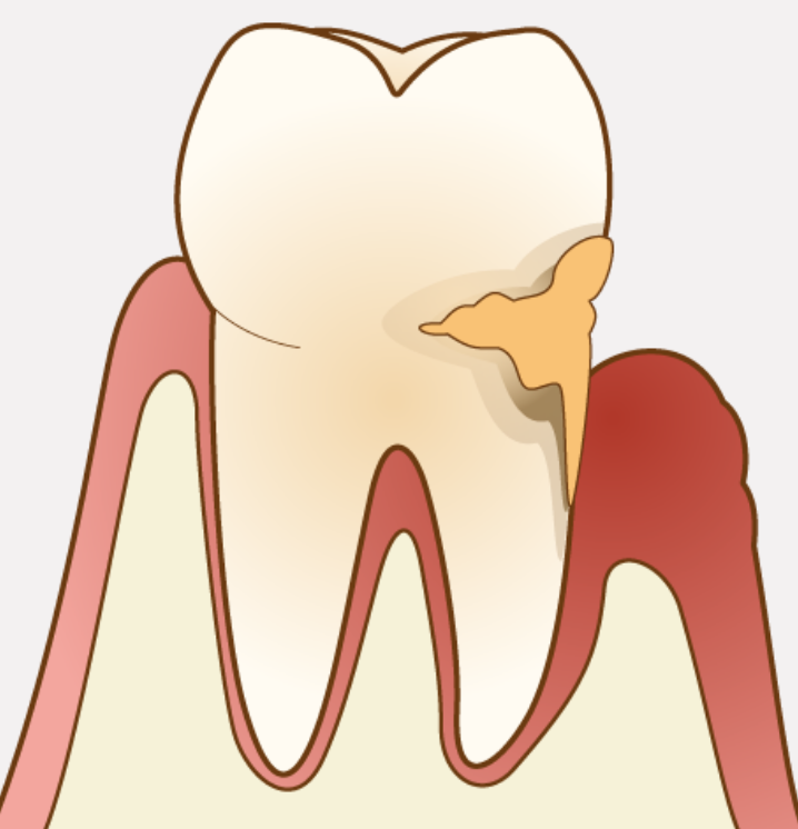 健康な歯でいるために歯周療法はとても大切です