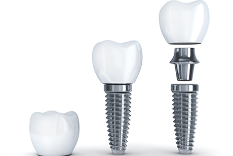 チタンで作られた人工歯根を埋め込みます