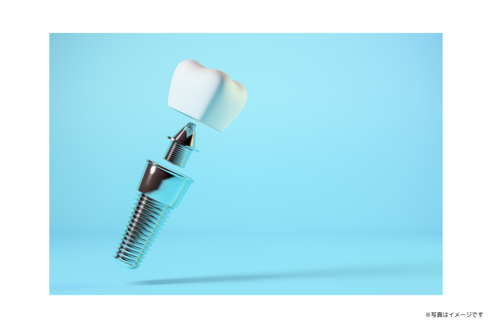 患者様の口腔内の健康維持を目的としたインプラント治療を行っています