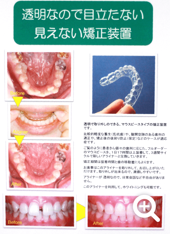 矯正をご検討中の方は、ぜひばば歯科医院までお気軽にご相談ください。