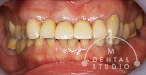 歯を残す”ための総合治療