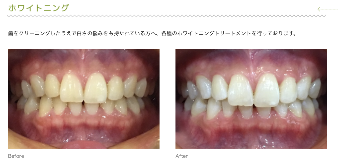 歯の白さに関するお悩みに対応するため、さまざまなホワイトニングトリートメントを行っています
