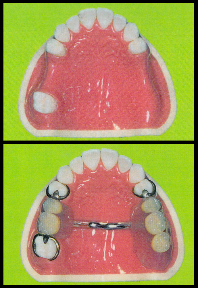 様々な義歯を取り扱っています
