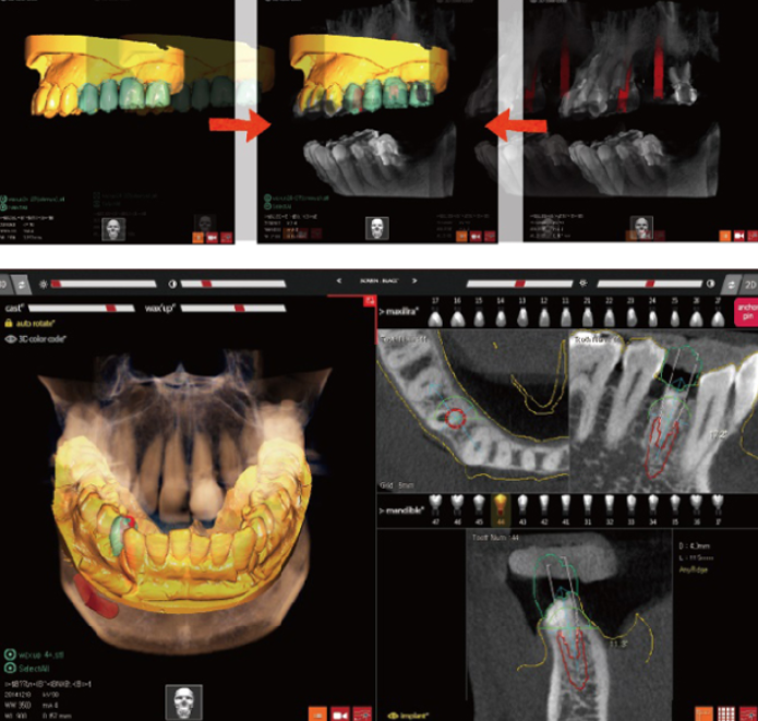 おくやまデンタルクリニックのインプラントシミュレーションシステム