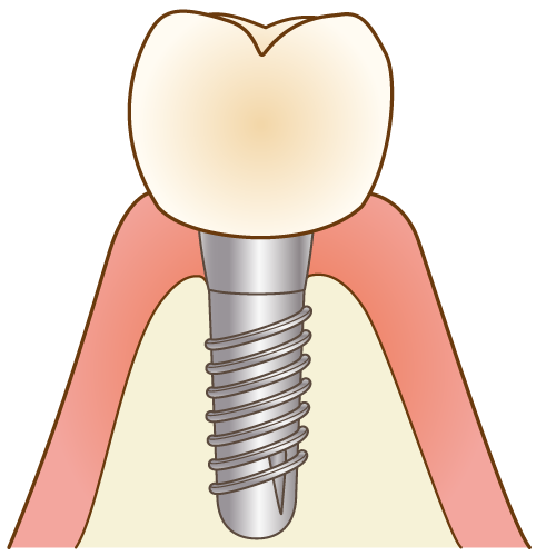 人工歯根を顎の骨に埋め込み、自然な見た目と機能を取り戻す治療です