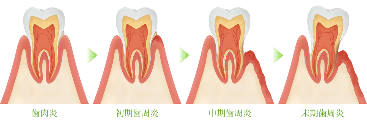 歯周病の進行を防ぎ、再発を抑えるための治療と予防管理を行っています