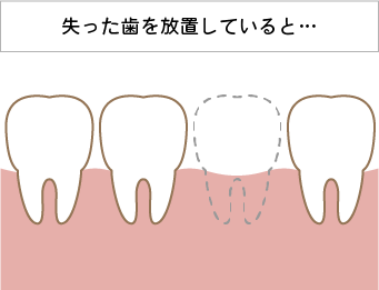 奥歯の銀歯や目立つ詰め物が気になる方へ、白色で目立たない素材を使った治療をご提案しています