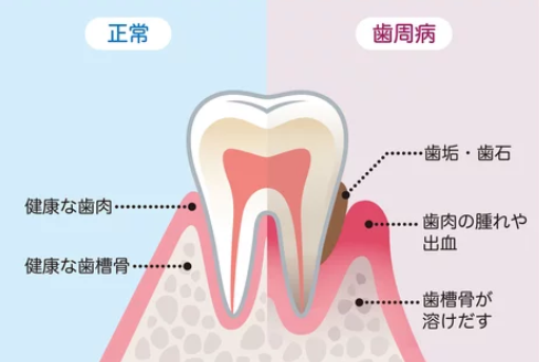 歯周病のイメージ