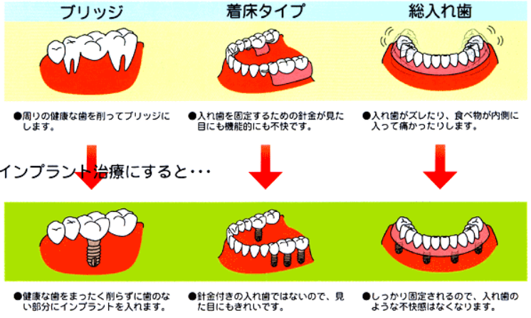 インプラント治療で今までより快適に過ごせるようになります