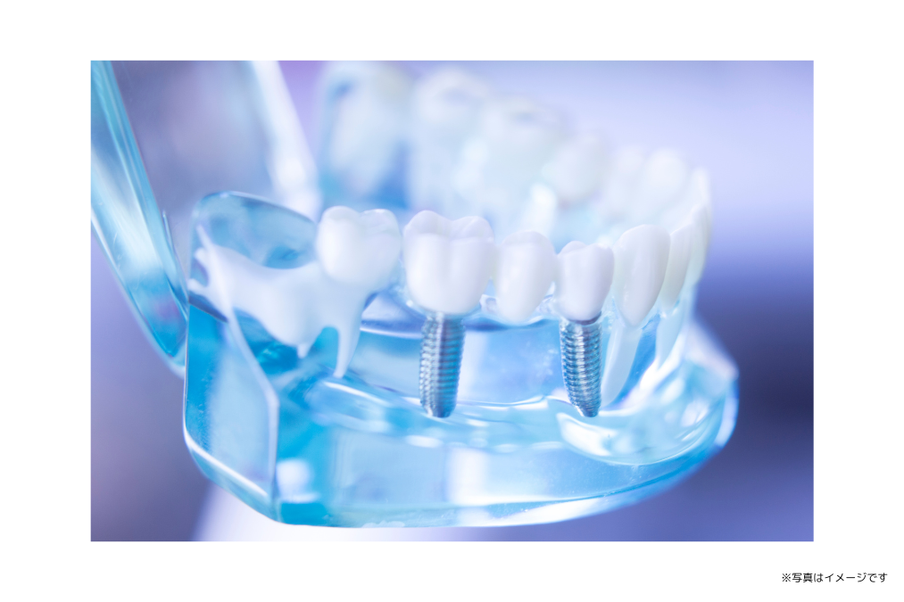 ノーベルガイドシステムにより、3Dシミュレーションで正確な治療計画を立案