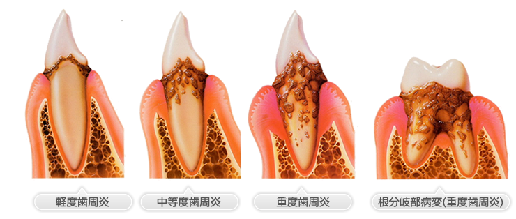 歯周病の進行の様子