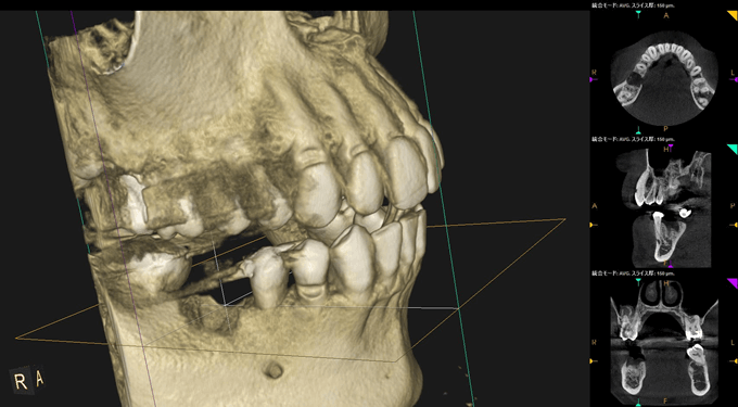３Ｄインプラント画像診断を導入しています