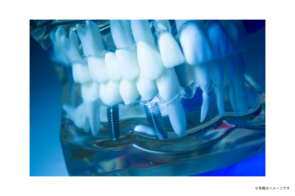 CTとシミュレーションで計画したインプラント治療を行います