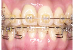 発育段階に合わせた矯正提案で将来の健康にも配慮