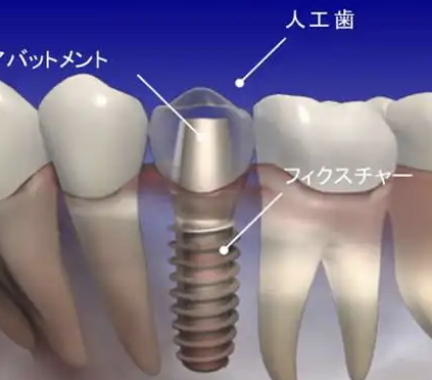 最新の人工歯をお試しください。