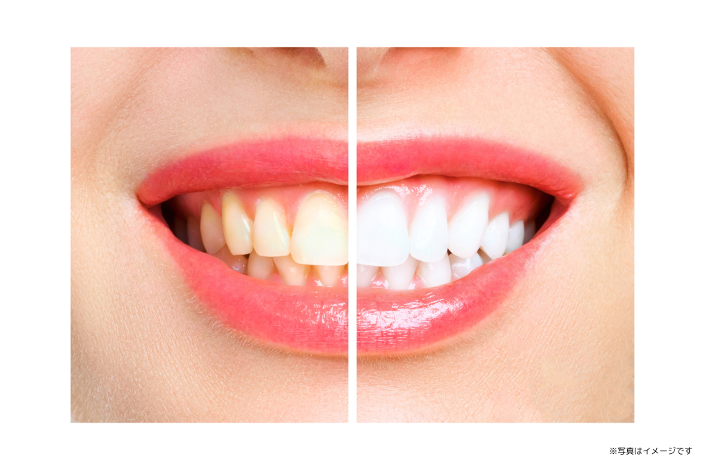 目立つかぶせ物や詰め物を白くする治療から、歯を白く輝かせるホワイトニング治療まで対応しています