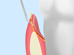 無自覚に進行する歯周病を徹底治療
