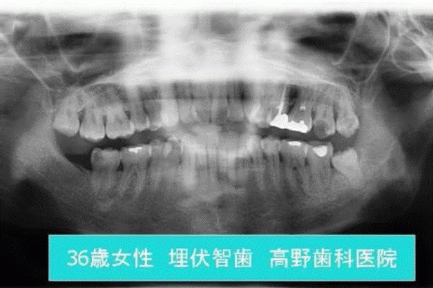 親知らずの抜歯から口腔内の嚢胞や腫瘤の治療まで、幅広い症例に対応しています