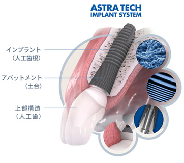 アストラテック社のインプラントシステム