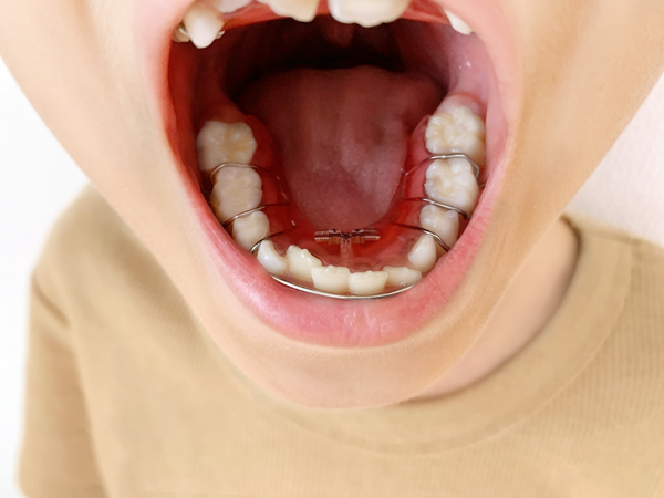 お子様に合わせた矯正治療を提案させて頂いております