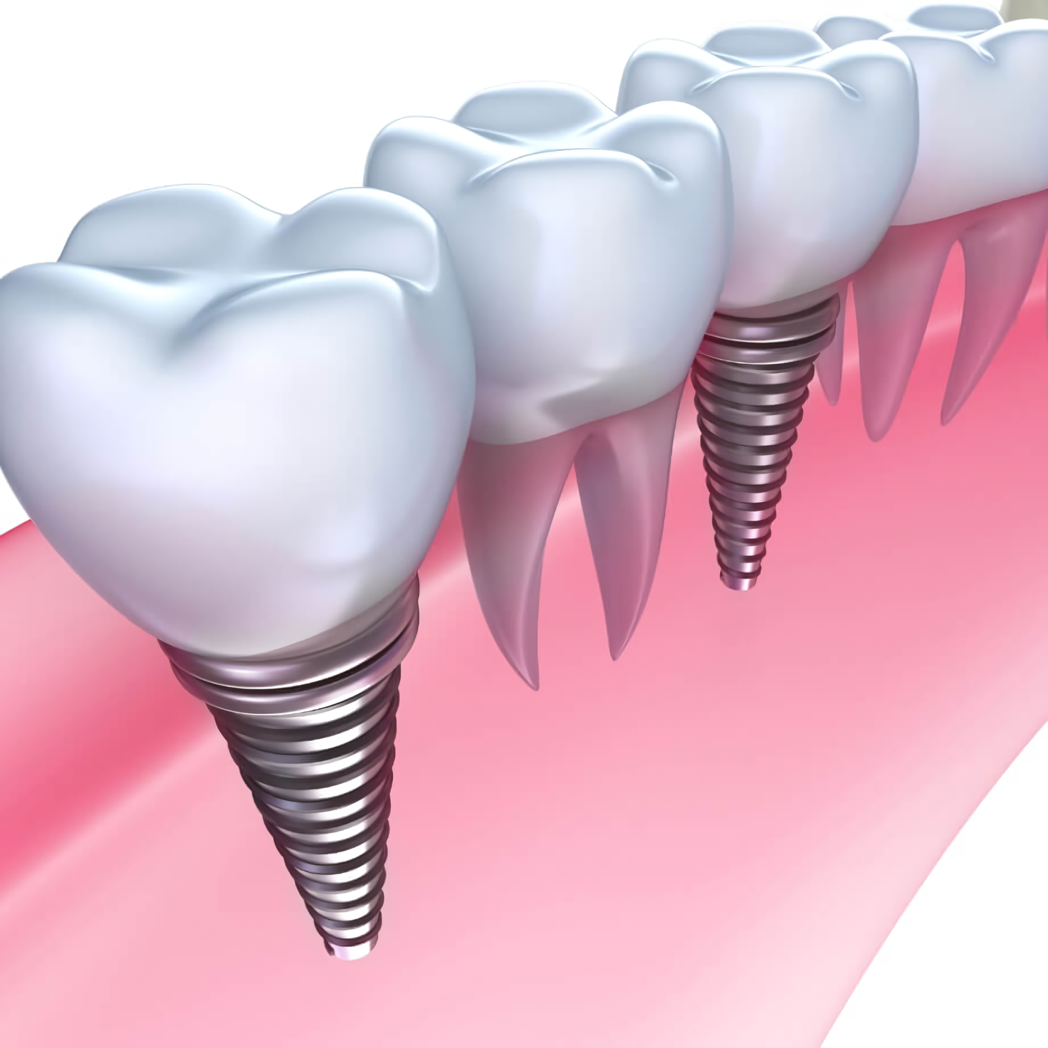 スウェーデン発祥の技術を活かした安心のインプラント