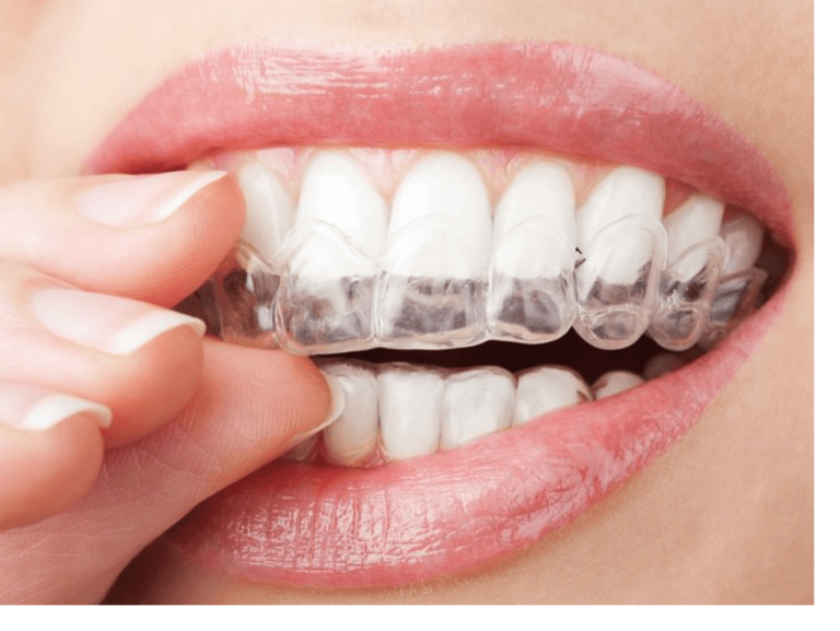 ホームホワイトニングをおすすめしています。※画像はイメージです。