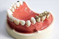 噛む力をデザインする補綴治療の流儀